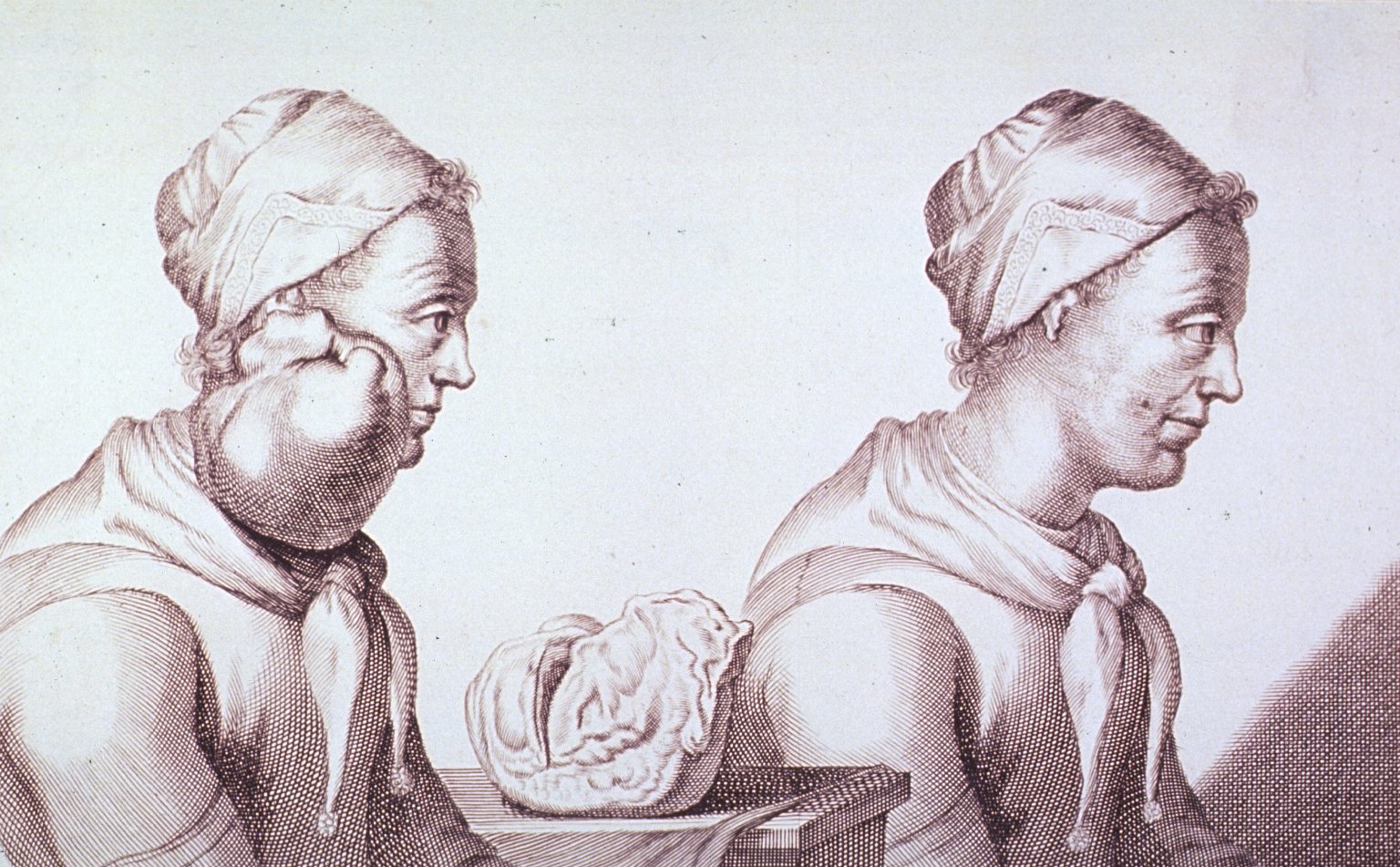 Engraving with two views of a Dutch woman who had a tumour removed from her neck.